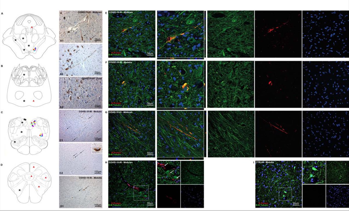 EricTopol's tweet photo. More on this from brain neuroinflammation in 24 patients and matched controls
https://t.co/t8JQqSx5B8 5 severe Covid patients had #SARSCoV2 immunoreactive neurons in brainstem nuclei https://t.co/GzfT2gjVMF