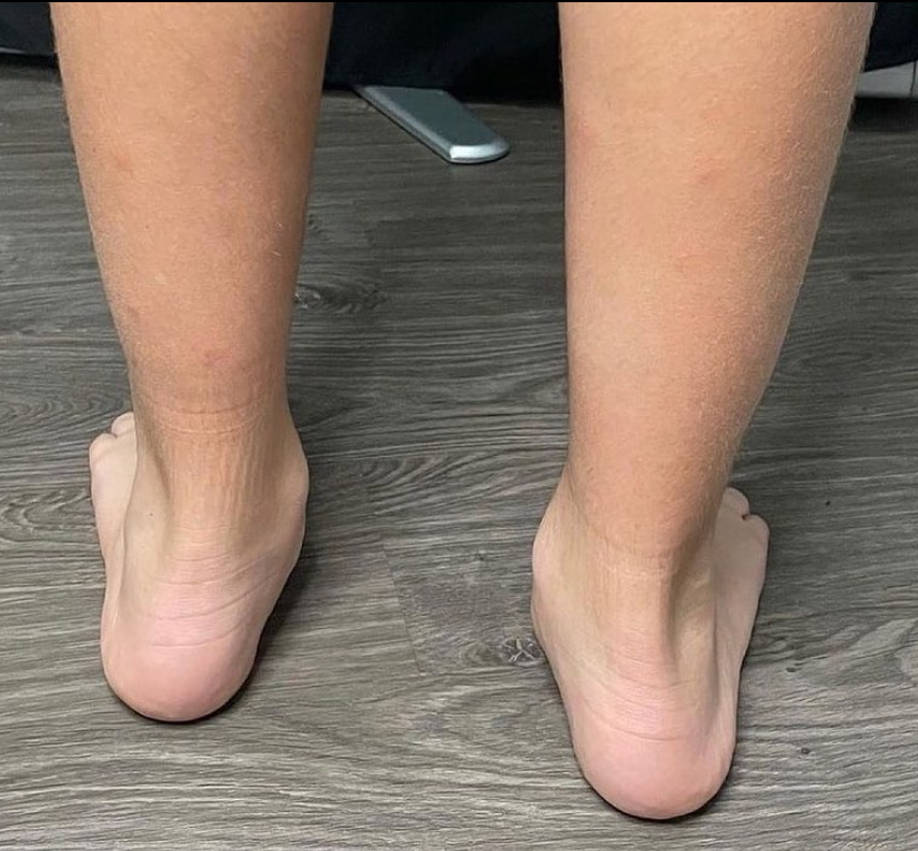 HyProCure's tweet photo. Repost• @integrativefoot Got flat feet? This is a very common condition that in many cases can be painful at any time throughout life.
Call for an appointment in West Palm Beach, Florida, USA, to learn more or visit https://t.co/p2LPfSnSLv
#hyprocure #flatfeet #overpronation https://t.co/8HUncU2pyO