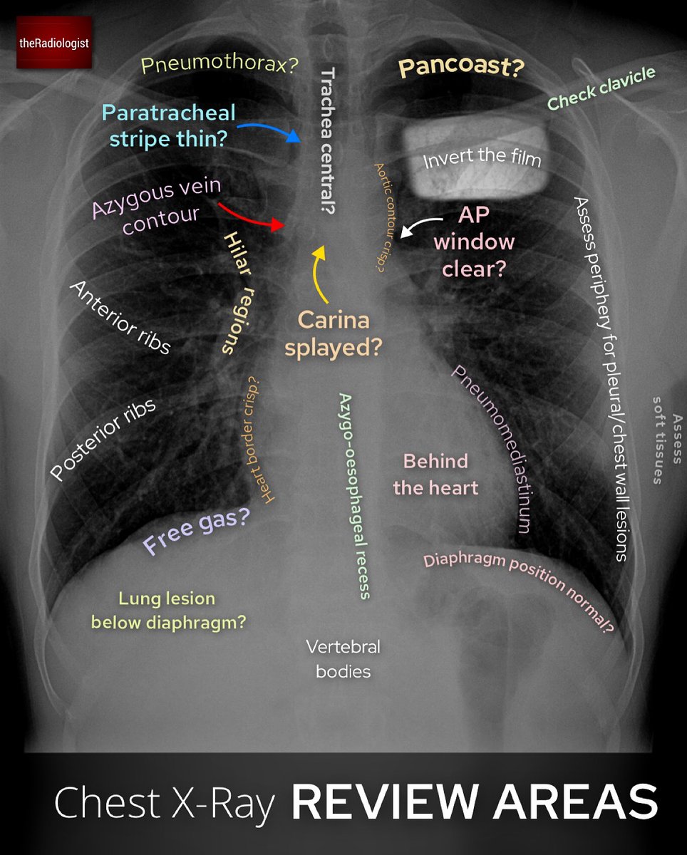Chest X-Ray review areas