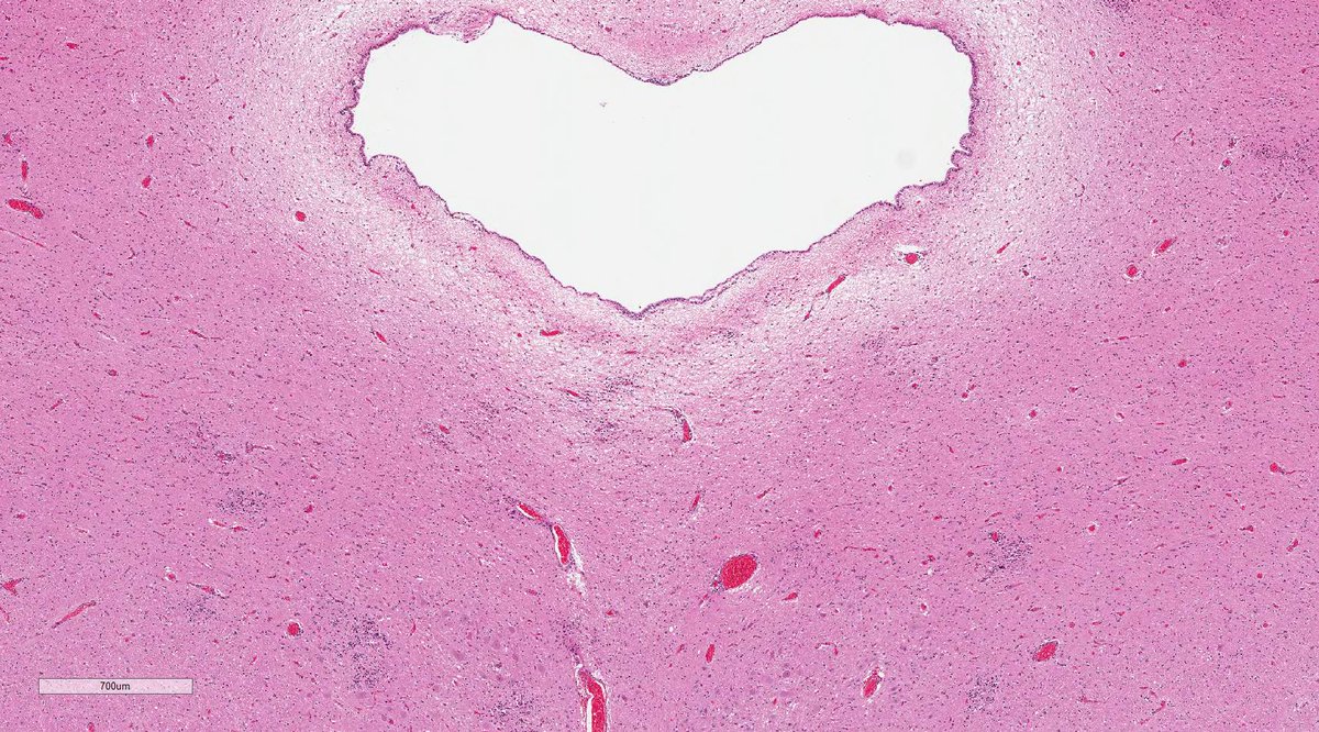 daoud_elena's tweet photo. Autopsy brain of an immunocompromised patient. Diagnosis? https://t.co/AXlU5hoD5P