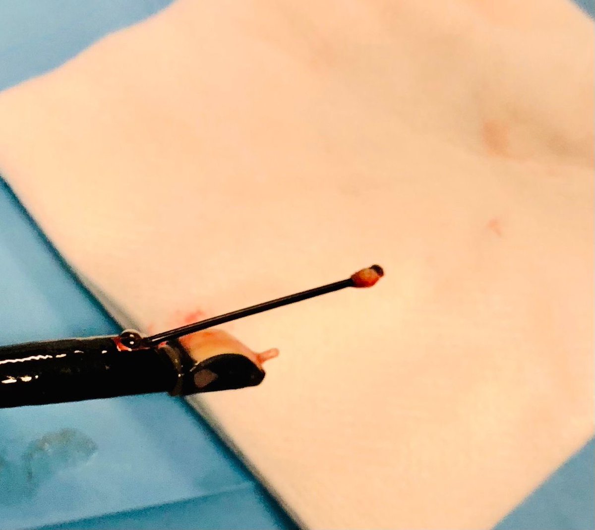 De la mano de @MiguelA45647567 y ERBE vas a conocer paso a paso y desde todos los ángulos la realización de #CRYOEBUS para biopsias transbronquiales de adenopatías.
Te esperamos en #MADRID los días 21-22 octubre 2022.
Plazas muy limitadas
Inscríbete ya!
videoforoneumologia.es/2022