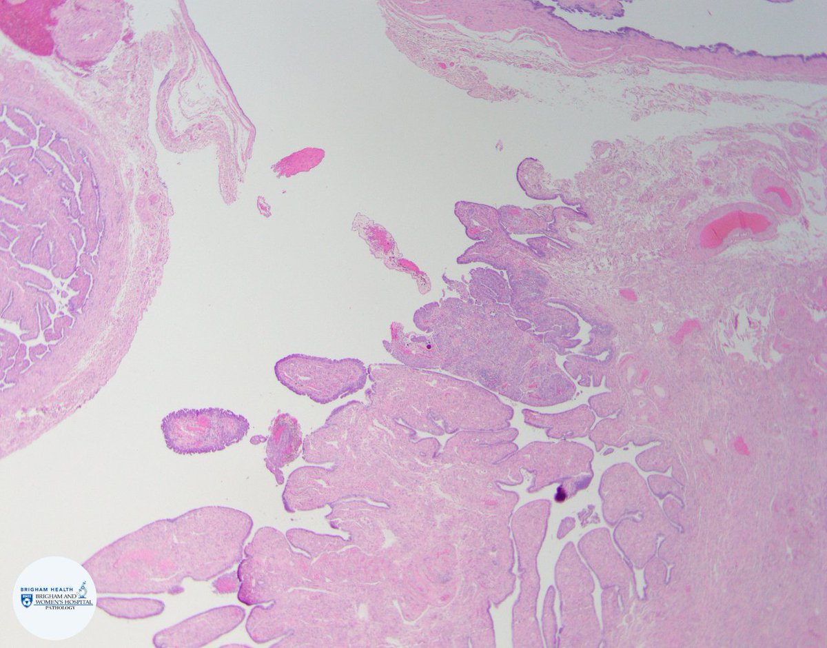 BWHPath's tweet photo. Fallopian tubes submitted with SEE-FIM protocol show  full thickness areas of highly atypical cells in the fimbria adjacent to areas of invasion on H&amp;E. What is your diagnosis? What studies would you consider? #BWHPathCotW #BWHGynPathSummer #pathology #GYNPath https://t.co/AAVmsGlPLd