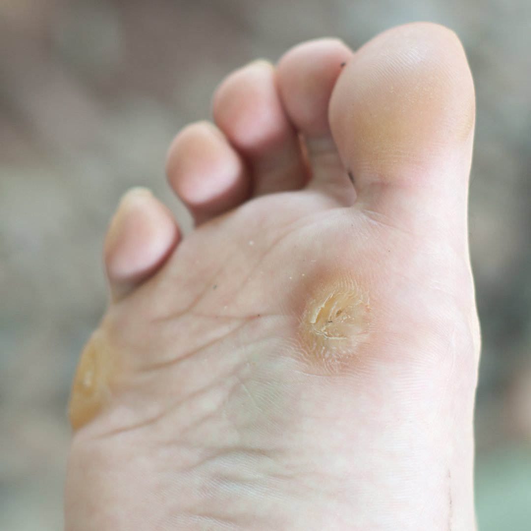 Did you know that #warts can spread from one person to another? Because #July is #WartAwarenessMonth, today #DrAnthonyWeinert is sharing his tips for dealing with stubborn #plantarwarts: bit.ly/3ndxLPz

#podiatristTroyMI #footdoctorTroyMI #ankledoctor #podiatrist