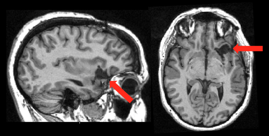 boeslab's tweet photo. What would you guess for a major change after this surgical lesion of the left frontoinsular junction?  

a)Difficulty switching from task to task
b)Sustained and effortless weight loss
c)Reduced ability to regulate emotion
d)Reduced awareness, as if life is on “autopilot” https://t.co/1w4j7lILgk