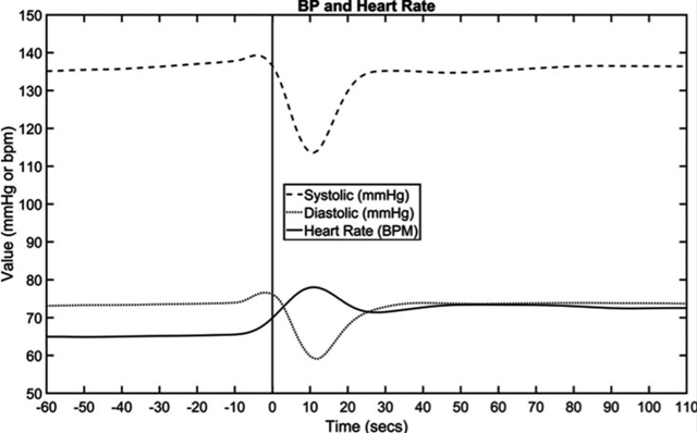 finapres's tweet photo. This study https://t.co/nsnAcDJoS8 showed that there is significant correlation between revascularisation status and autonomic function determined by speed of heart rate recovery. The #heartrate and #bloodpressure of the participants were measured using #Finapres devices! #cnibp https://t.co/B8pDWGwxuE