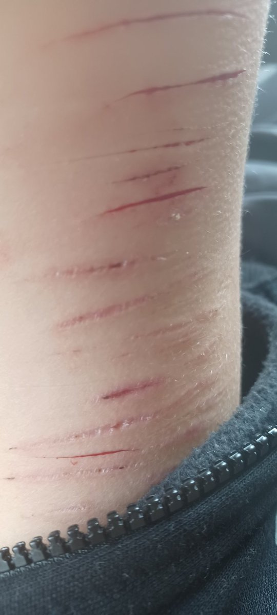 LEE90854662's tweet photo. Tw: self harm, shtwt, styro, styrotwt, cuts, blood
.
.
.
Baby styros heheh https://t.co/Msmy7OJfxZ
