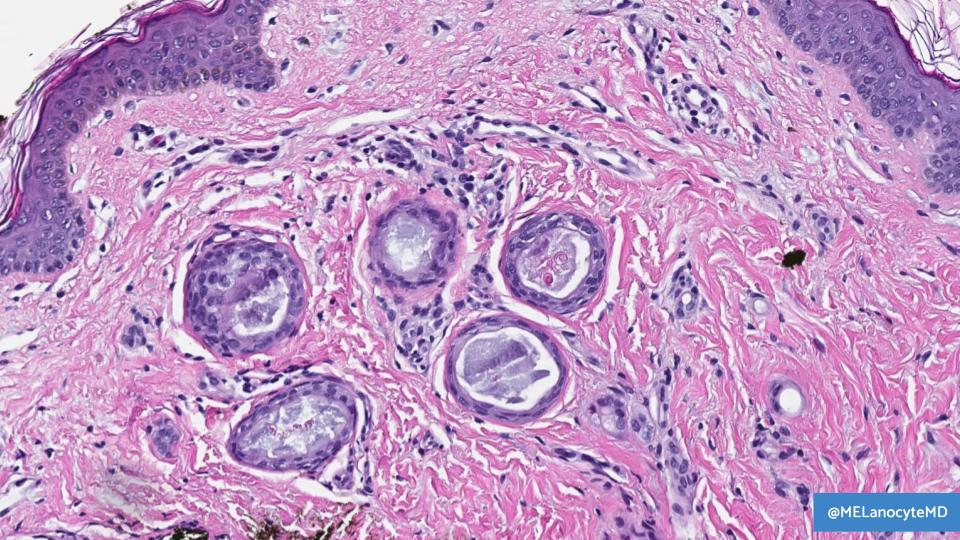 Syringoma:
1️⃣ Papules on face, esp. eyelid 👁️
2️⃣ Superficial proliferation of paisley/tadpole sweat ducts (NO keratin cysts)
3️⃣ Clear cell variant a/w diabetes mellitus 🍬

#3thingstoknow #dermpath