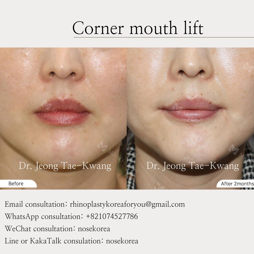 showmethedoctor's tweet photo. Corner Lip Lifting' Before &amp; After 
Mano plastic surgery clinic. 
DR. Jeong Tae-Kwang
#cornerlip 
#cornerliplift
#cornerliplifting
#mouthplasticsurgery
#dr_jeong_tae_kwang
#mano_plastic_surgery_clinic https://t.co/JSPKEqm0RR