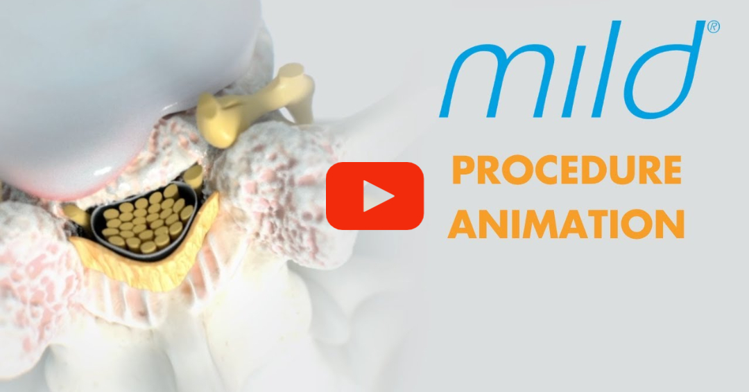 Relievus's tweet photo. mild® is a safe procedure that can help patients diagnosed with lumbar spinal stenosis (LSS) stand longer and walk farther with less pain.
Watch this animated video of mild® procedure.
https://t.co/QIRNDO6vAG
https://t.co/jyeBQAJnR2
888-985-2727
#mildprocedure #relievus https://t.co/9kycHsr80d