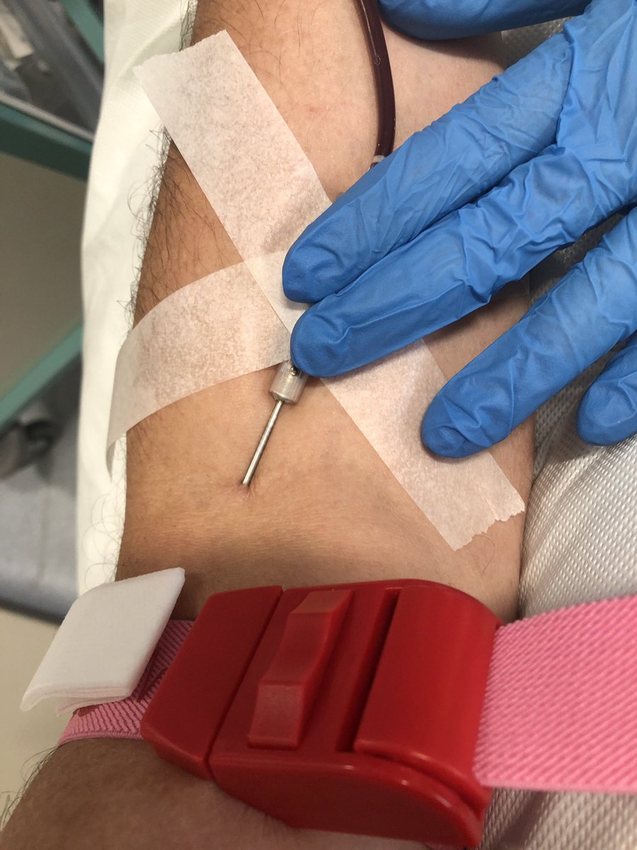 wolf_alba's tweet photo. @IronOverloadUK #haemochromatosis 11 x #Venesection based on Ferritin levels I’m 63% of the way to #MaintenancePhase 😊. Question 🤔 I’m tracking my results and noticed that my Ferritin levels dropped a lot more over the initial 5 pints than the second 5 pints - is this normal? https://t.co/xVfBrE6PIn