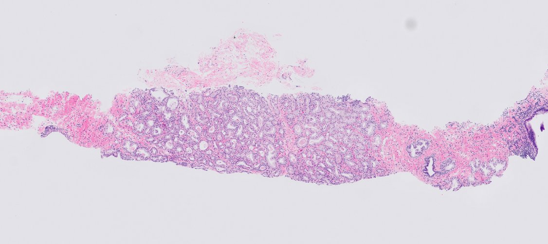 chemily7's tweet photo. Almost reflexively called this 3+3 (there was high-grade PCa in every other part of this case). We don't often see adenosis on bx (more often seen in transition zone/TURP), but clues here are: no significant cytologic atypia and basal cells appreciated at higher power #gupath https://t.co/rmpObpNWLP
