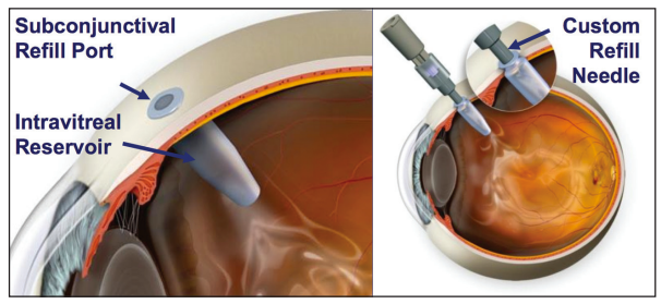 TheLens_oph's tweet photo. A port delivery system for ranibizumab can ⬇️⬇️⬇️ #eyeinjections frequency in patients requiring anti-VEGF for nAMD. How does this influence cost of care & monitoring frequency? @JAMAOphth @raviparikhmd @sheflisood12 @nyulangoneeye @NYU
https://t.co/GMcP7k1EWO https://t.co/H37VU99XD8