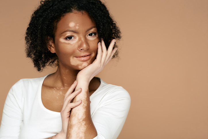 Simcoderm's tweet image. Recruiting volunteers aged 12 or older diagnosed with  #vitiligo to participate in a 14-month research.

For more information call us at 7055036331 or email us at trials@simcoderm.com