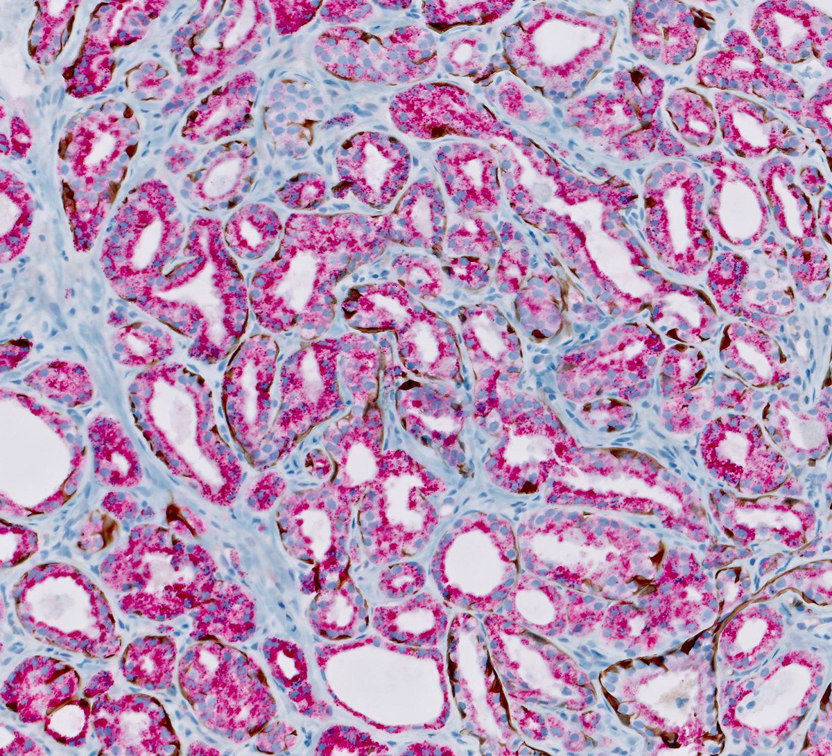 chemily7's tweet photo. Almost reflexively called this 3+3 (there was high-grade PCa in every other part of this case). We don't often see adenosis on bx (more often seen in transition zone/TURP), but clues here are: no significant cytologic atypia and basal cells appreciated at higher power #gupath https://t.co/rmpObpNWLP