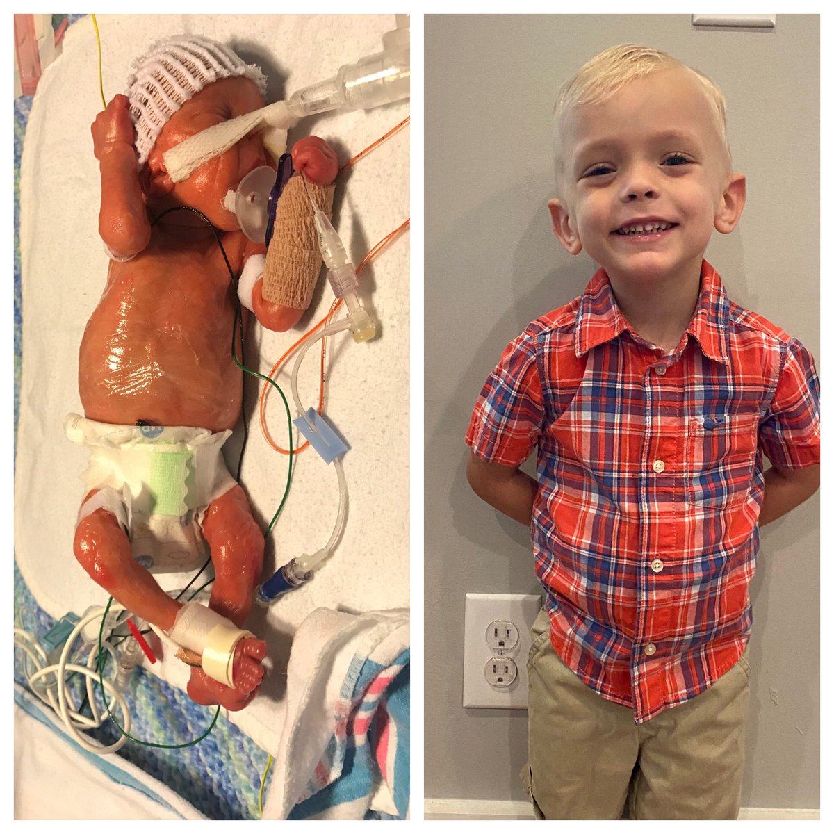 My water broke at 22 weeks 1 day (this is called PPROM.) Many women are told that this situation means “0% chance of survival” and/or “no quality of life if the baby survives” and/or “termination is the only option.” 
None of the above is true. Here is my 0%
