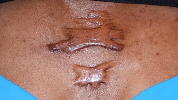 DID YOU KNOW???

When you get injured, in the healing process your body might form scars to heal the wound, certain times there is accumulation of excessive amount of collagen resulting in a raised scar which do not regress. This is known as a KELOID (raised scar).
