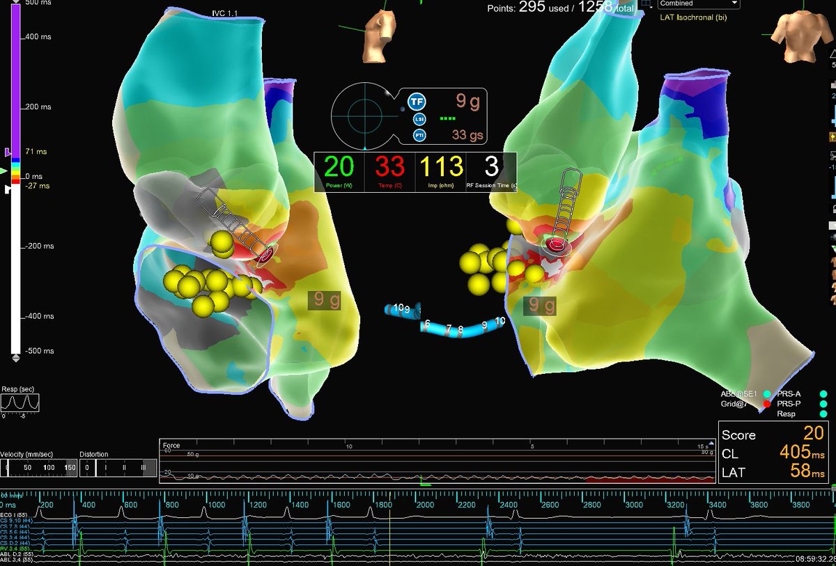Incessant Parahisian AT w/earliest signals mapped to right anterior septum w/sharp HIS deflection present. Detailed mapping of NCC with #HDGrid on #EnsiteX allowed for safe ablation (w/o HIS signal present) and termination of AT in 3 seconds. <a href="/AbbottCardio/">Abbott Cardiovascular</a> Map credit: <a href="/CPaskman/">Chelsea Paskman</a>
