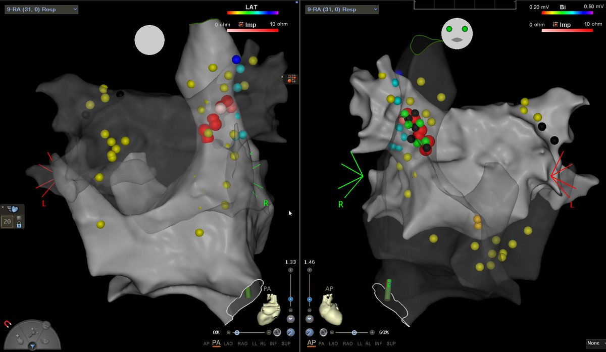 GP ablation for #vasovagal #syncope. Ant RPV only sensitive site (black), adj post SVC unresponsive. Pure #vasodepressor. HR up 20 bpm, BP up 30 mmHg. Close #Phrenic capture (blue). Maps by <a href="/therealKedarB/">Kedar Balakrishna</a> #Epeeps <a href="/EPeeps_Bot/">EP_Bot</a> <a href="/DrRoderickTung/">Roderick Tung</a> <a href="/uazmedphx/">UAZ Medicine - Phoenix</a> pic.x.com/zyvJkW4amN