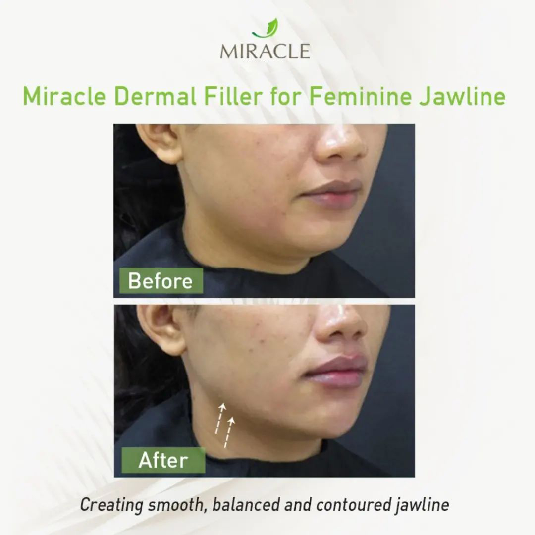 Miracle_Clinic's tweet photo. #JuvedermVolux adalah jenis #DermalFiller generasi terbaru yang efektif untuk membentuk garis rahang lebih jelas. Terlihat perbedaan hasil foto before &amp; after dibawah ini, rahang lebih ramping dan dagu lebih terisi 😍.

Konsultasikan di Miracle Clinic!
📱https://t.co/yWCUeA9iqr https://t.co/DDF9GPBwUG
