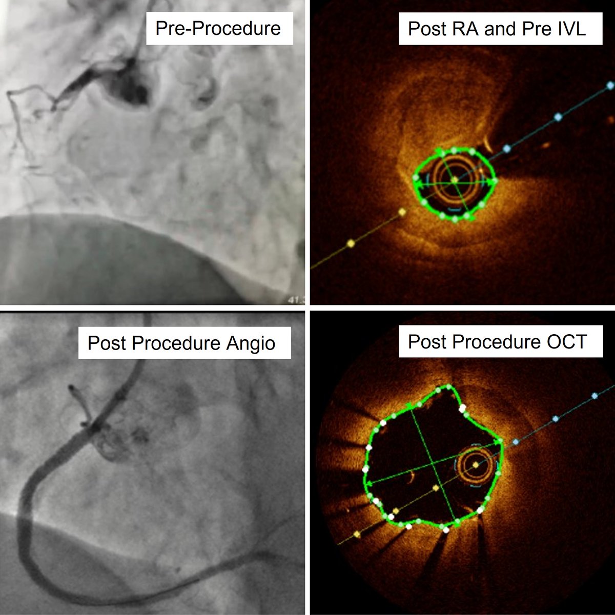 ShockwaveIVL's tweet image. Congratulations to Prof. Ge Jun-Bo on the 1st #CoronaryIVL case in China! CTO in the RCA with severe calcium treated with #RotaShock approach to an excellent outcome. Look forward to many more cases in China to come!

ISI bit.ly/3iEq7fC #CardioTwitter #ComplexPCI