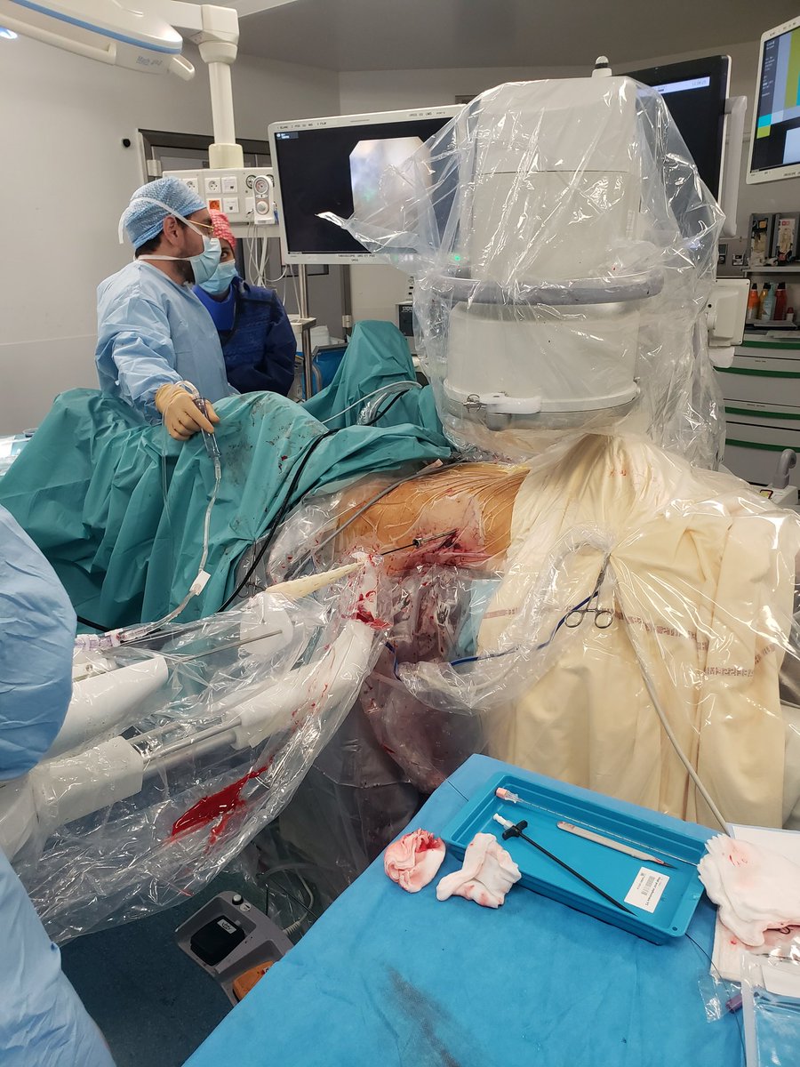 Housbow's tweet photo. World premier! First PCNL with flexible URS ILY Robot assisted Possible because of its size and 🎮!
 
Pr @sdroupy
Dr Ben-Naoum 
Dr @Nisrine_BAKRIM 

@CHUNimes 

Let's destroy stones 🎮 🦾 

#rirs 
#pcnl
#endourology 
#madeinfrance 
@Talkabouturolo1 
@AFUrologie 
@Uroweb https://t.co/n34QUhcKNs