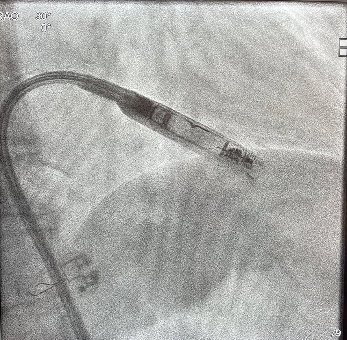 HanyDemo's tweet image. Excited to be the first hospital system in Illinois to implant the new AVEIR leadless pacemaker. What a great and exciting technology that will benefit our patients. We implanted 3 #AVEIR today. #forwardtogether @NorthShoreWeb @SwedishChicago @AbbottCardio @AbbottGlobal