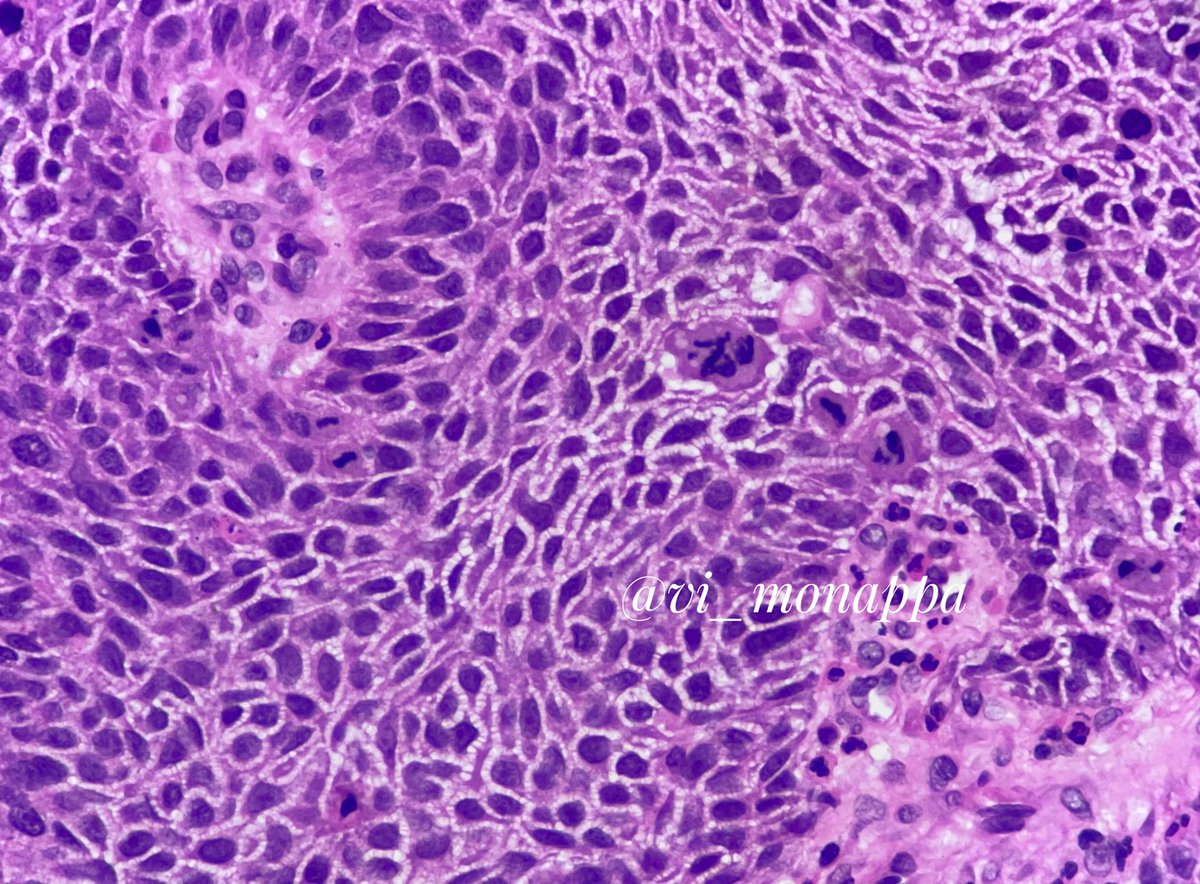 vi_monappa's tweet photo. When tumor cells learn English and try to communicate 😁
Zoo? Or zoom? #pathfun #pathtwitter https://t.co/Ft4eynhZ41
