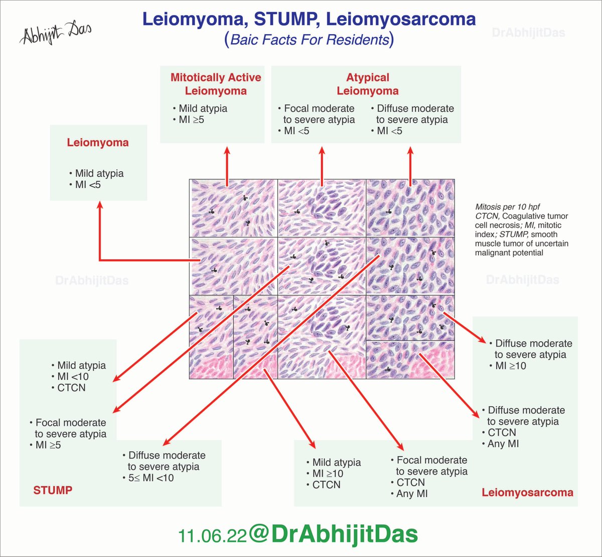 Leiomyoma, STUMP, Leiomyosarcoma (Basic facts for residents) •Three scenarios to make a diagnosis of STUMP (smooth muscle tumor of uncertain malignant potential) •CTCN forms distinct border with viable tumor tissue #BasicFactsForResidents