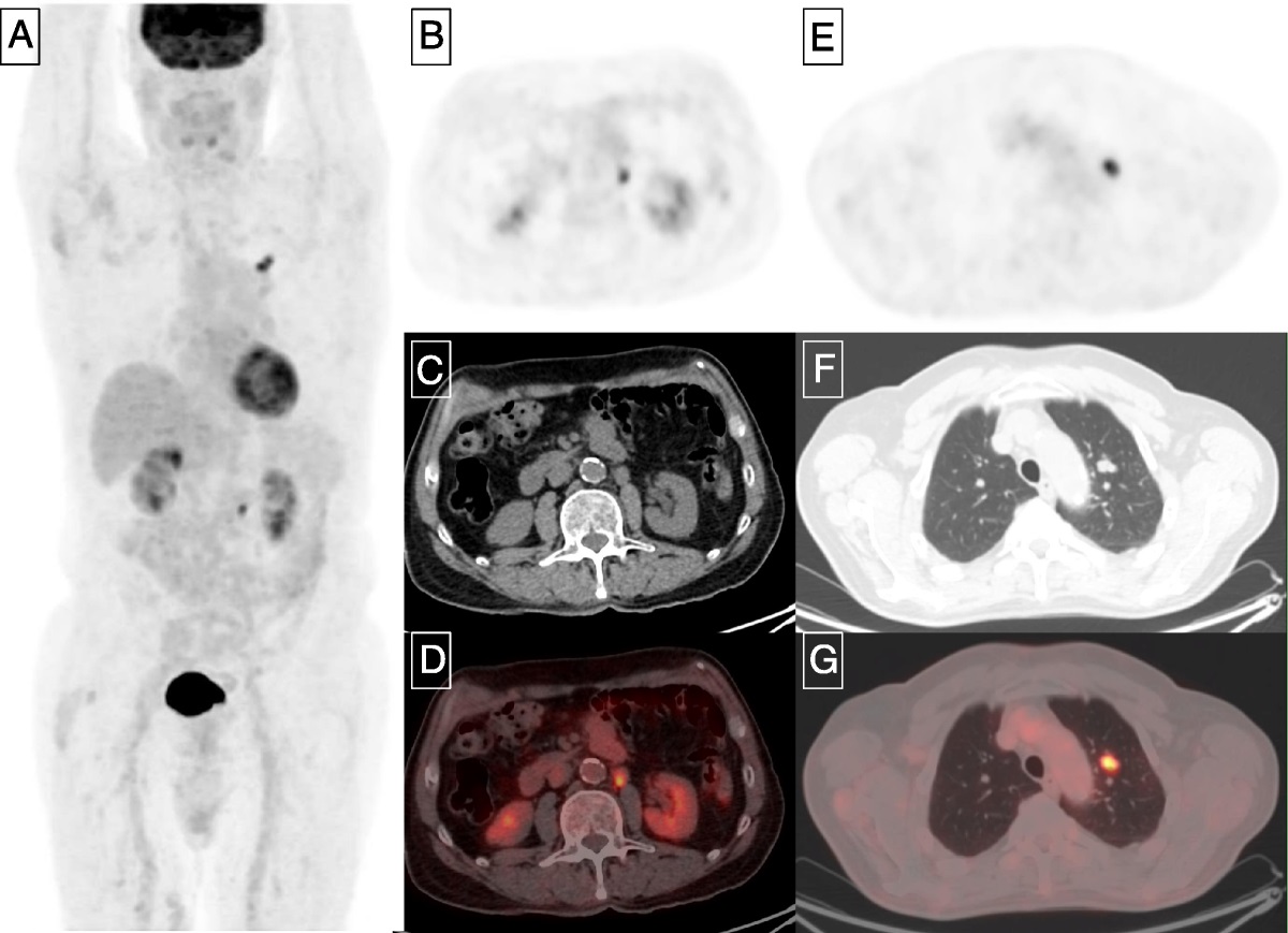 Current Issue: 18F-FDG and 68GA–Prostate-Specific Membrane Antigen PET/CT Perform Better Than CT Alone in Restaging Papillary Renal Cell Carcinoma Recurrence dlvr.it/ST6L74