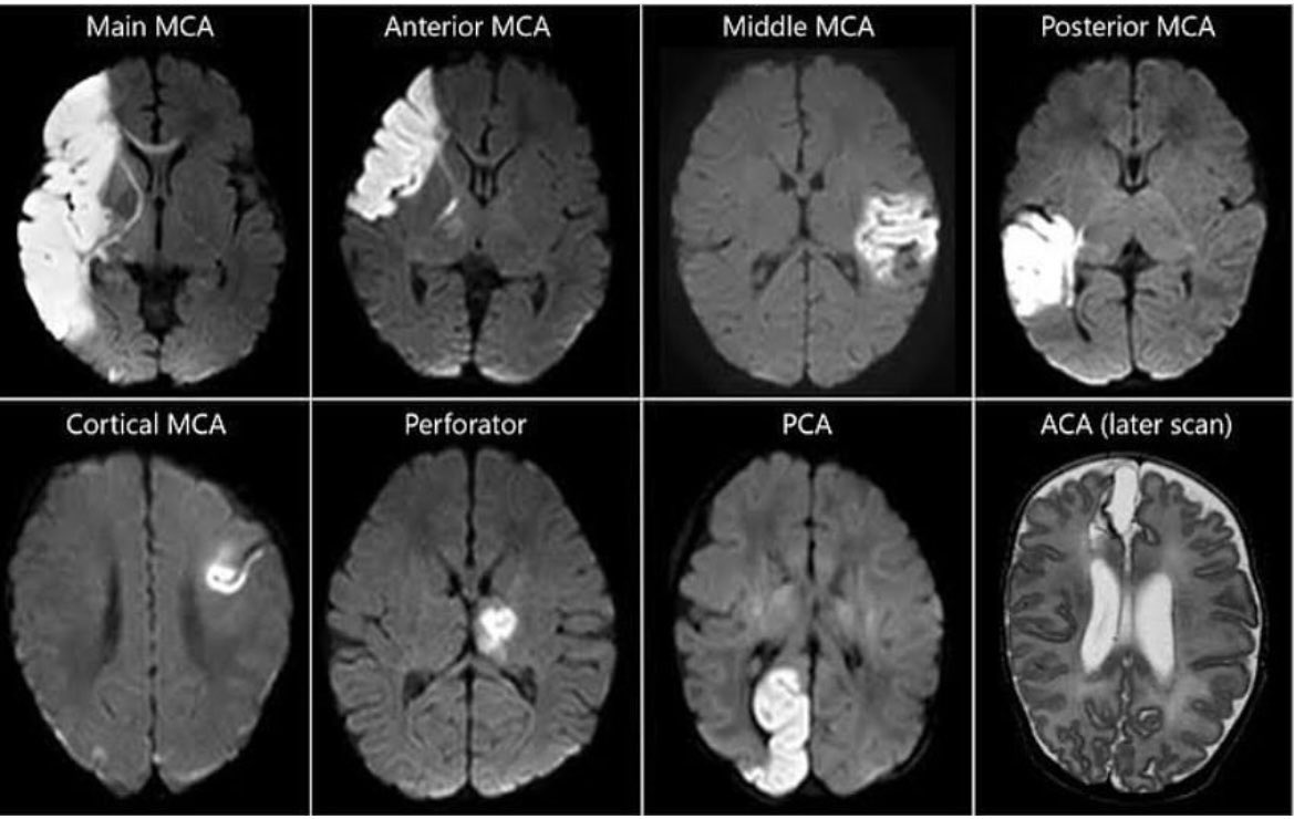 Help with your vascular territories on Brain MRI.
