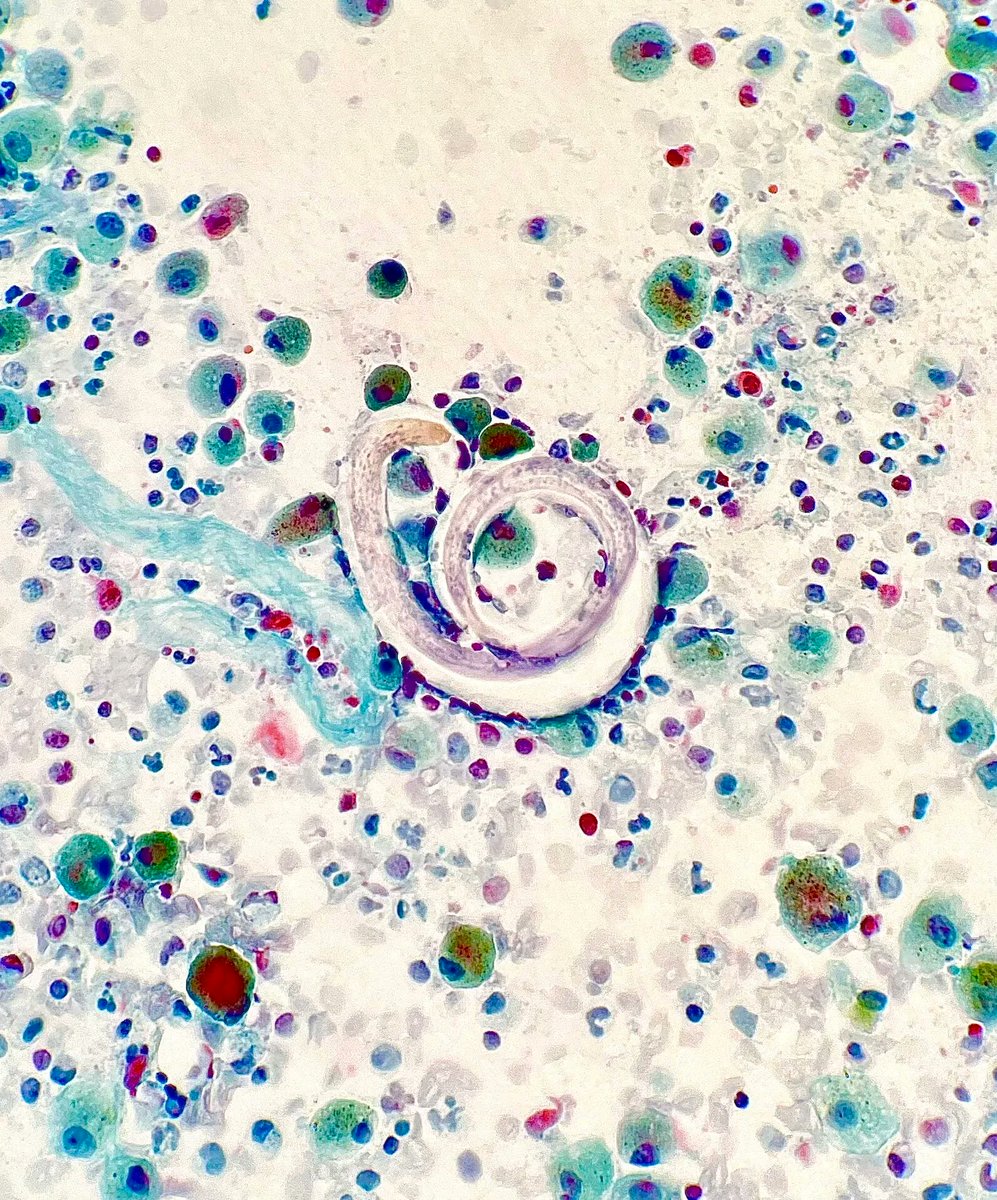 Bronchoalveolar lavage revealing larvae of what species? Answer: kikoxp.com/posts/12778   #PathTwitter #IDTwitter #MedTwitter