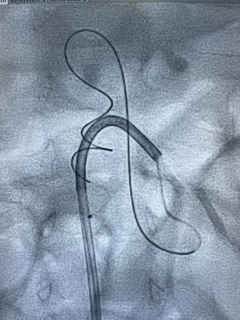 AgrimNeuro's tweet photo. Large arteriovenous fistula in the spine at D12 level, causing cord compression. The fistula was from the anterior spinal artery necessitating precise occlusion. https://t.co/3t2mocM4Sm