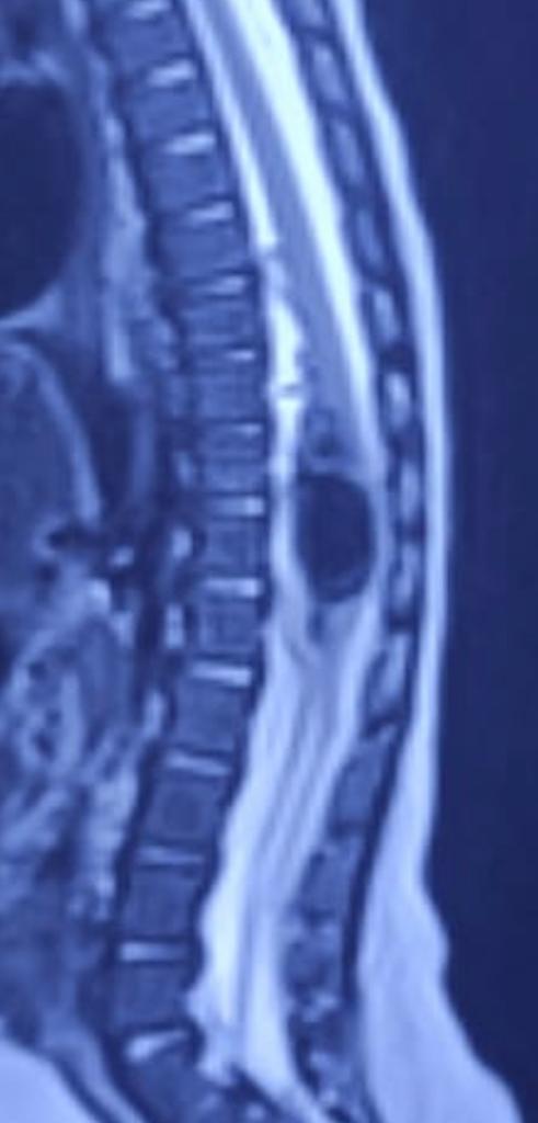 AgrimNeuro's tweet photo. Large arteriovenous fistula in the spine at D12 level, causing cord compression. The fistula was from the anterior spinal artery necessitating precise occlusion. https://t.co/3t2mocM4Sm