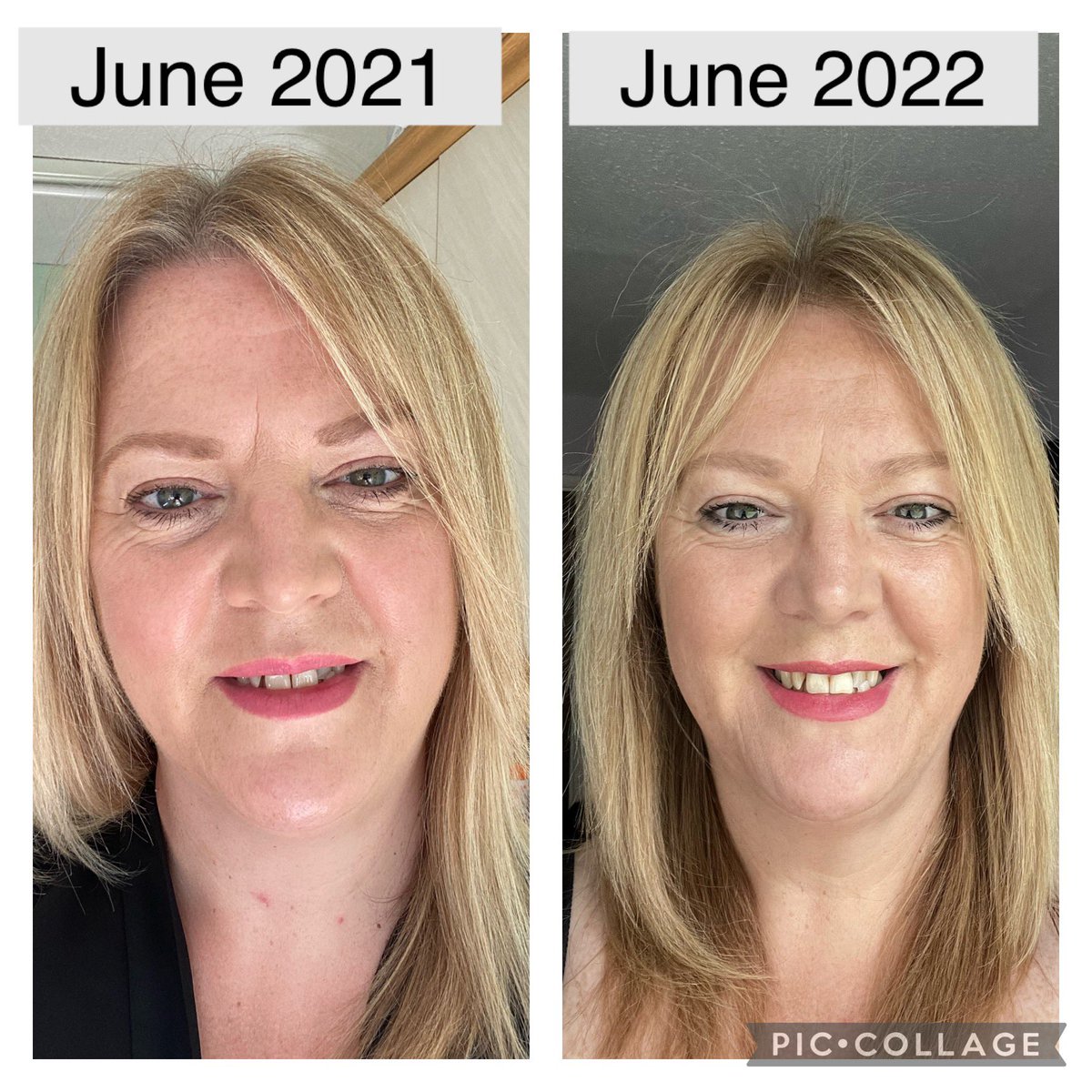 What a difference 1 year makes 🌟

If you want to know what I’ve done to get my skin like this comment below 👇

#fallbeauty #beautymood #skincare #pretty #life #style #beautiful #beautybloggers #beautytips 
#wakeupandmakeup #ThrowbackThursday