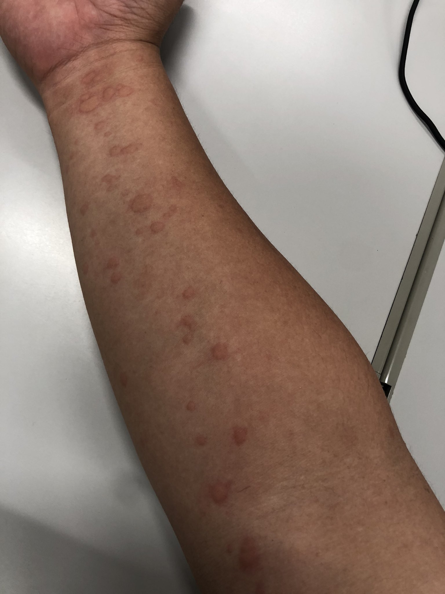 ほんとーch なかなか治らなーい あ でもちょっとかゆいだけだよ クエン酸と重曹を試す予定です 蕁麻疹 T Co 0idfndr0i6 Twitter