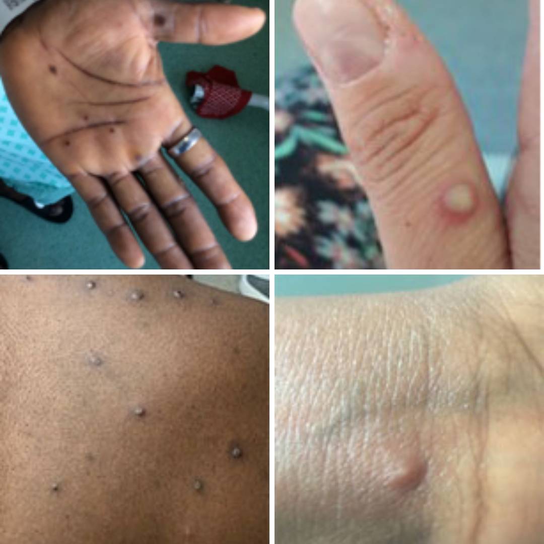 O que você precisa saber agora que a varíola do macaco já tem transmissão comunitária no Brasil 

Especialistas explicam o que ainda é um mistério sobre a doença e quais cuidados devem ser tomados no cenário atual r7.com/5_b3