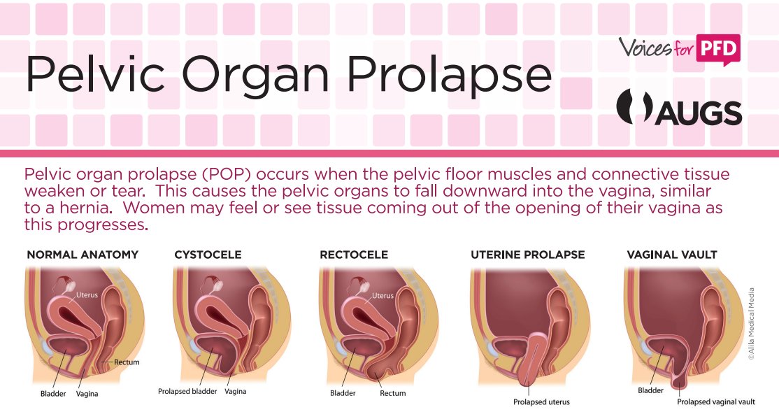 Voices for PFD on X: June is #POPAwarenessMonth! Pelvic organ #prolapse is  the dropping of the pelvic organs caused by the loss of normal support of  the vagina. Check out our POP