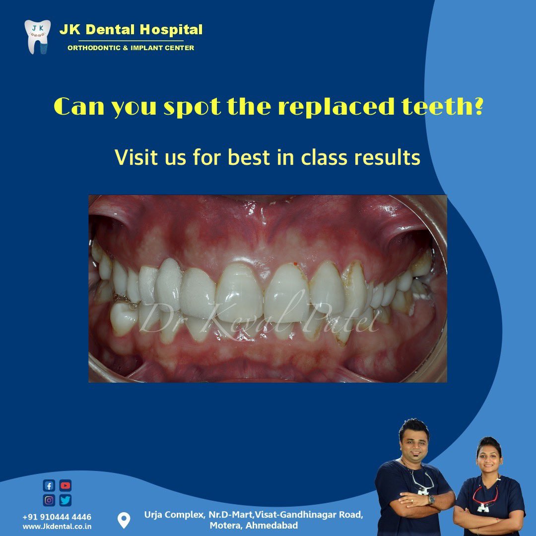 JKDENTALORTHO's tweet image. Highly durable high in strength ZIRCONIA crowns were delivered at @JKDENTALORTHO , Ahmedabad.
We have best dentist in Chandkheda at our best dental clinic.
Visit us for your one step dental solution.

 #trending #invisalign #braces #aligner #chandkheda