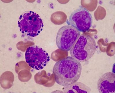 Nueva#ImagendelmesGECHEl hallazgo de trombocitosis, mielemia y basofilia en sangre periférica o....