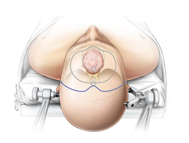 #NeurosurgicalAtlas: Chapter dedicated to detailing the steps of a bifrontal craniotomy. Image demonstrates a single burr hole option for turning the craniotomy. neurosurgicalatlas.com/volumes/crania…