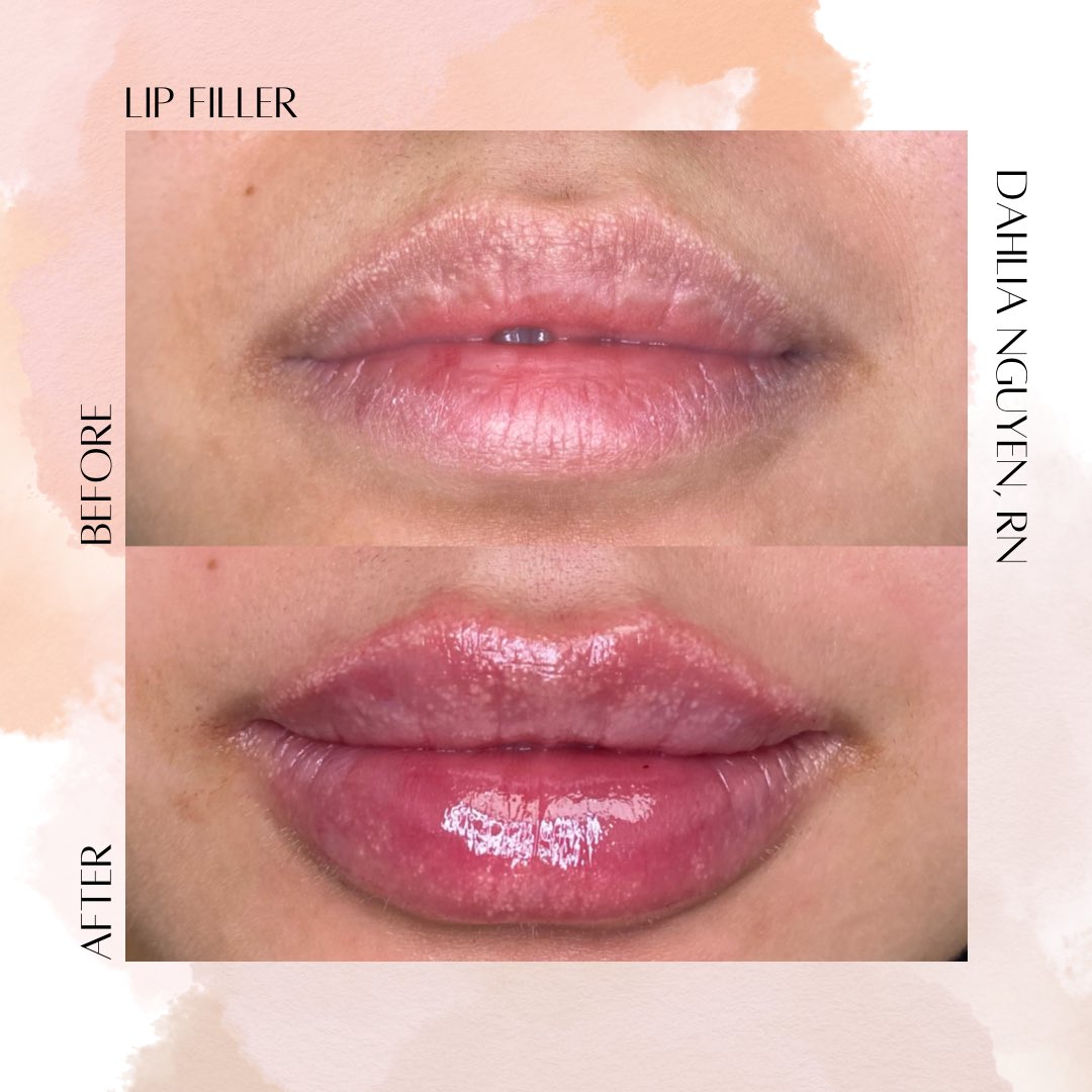 dahliaplz's tweet photo. Woooooo my fav lips that I did this week! Don’t miss out on our 249$/half a syringe or $498/full syringe promo for July only!!! https://t.co/AuiNkrRqy2