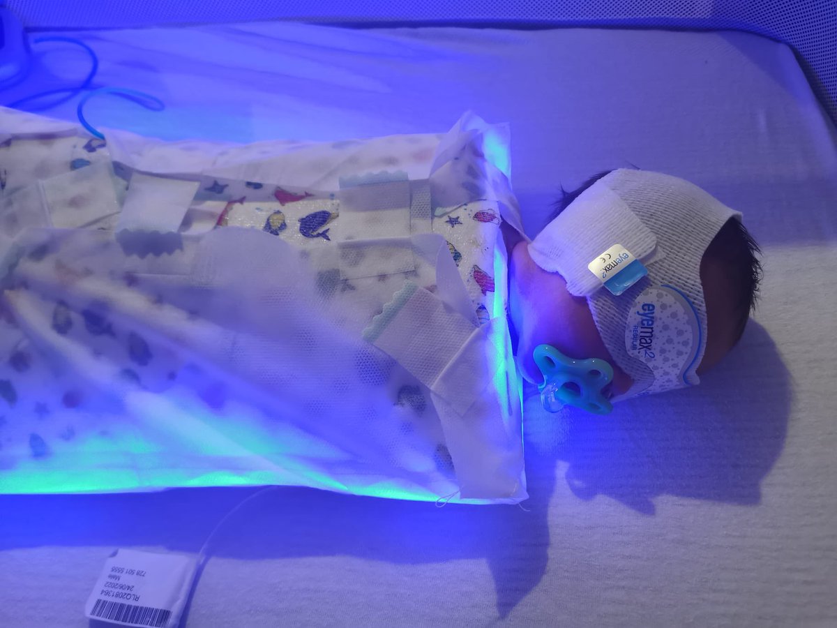 Elaine π (@elaineevans110) on Twitter photo We are excited to share that this is our first baby <a href="/WyeValleyNHS/">Wye Valley NHS Trust</a> to have home phototherapy. So proud of our neonatal outreach team and all the time and effort they have invested in this to be able to launch this service. Shared with permission of the family. @lapeers72 <a href="/WMNODN/">West Midlands Perinatal Network</a> We are excited to share that this is our first baby <a href="/WyeValleyNHS/">Wye Valley NHS Trust</a> to have home phototherapy. So proud of our neonatal outreach team and all the time and effort they have invested in this to be able to launch this service. Shared with permission of the family. @lapeers72 <a href="/WMNODN/">West Midlands Perinatal Network</a>