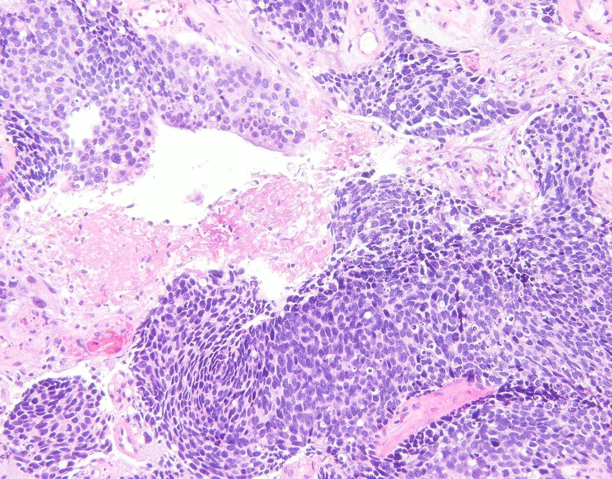 Esther Adler, MD (@drestheradler) on Twitter photo Cervical mass biopsy. What's your differential diagnosis? What stains/additional information would you like? #Pathology #GYNpath #Meded <a href="/NYUGSOMpathres/">NYUGSOM Pathology Residency</a> <a href="/nyugrossman/">NYU Grossman School of Medicine</a> Cervical mass biopsy. What's your differential diagnosis? What stains/additional information would you like? #Pathology #GYNpath #Meded <a href="/NYUGSOMpathres/">NYUGSOM Pathology Residency</a> <a href="/nyugrossman/">NYU Grossman School of Medicine</a>