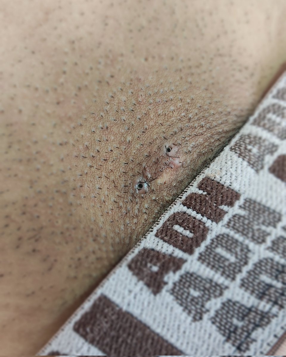 KarlyPiercer's tweet photo. Pubic realizado com surface
Procedimento com 40 dias de cicatrização! 
Topos em opala azul 4mm https://t.co/W7eYK7bQK6