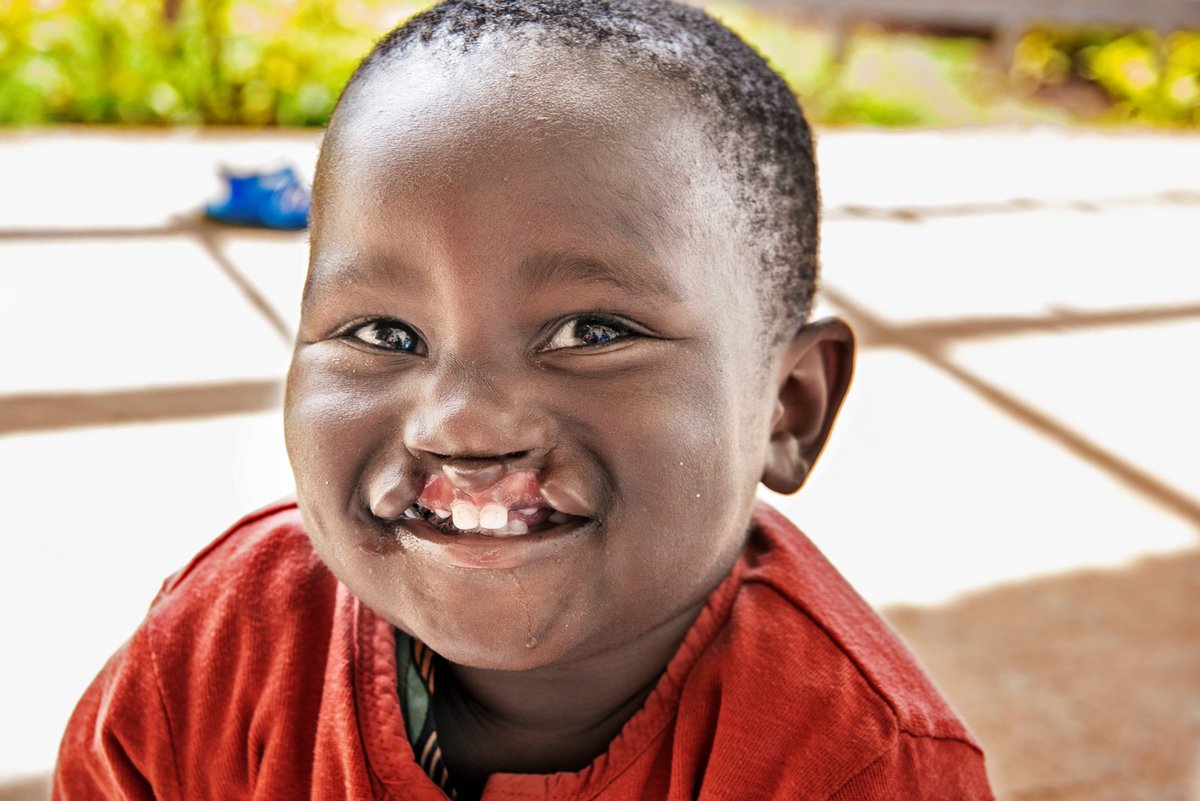 OpSmileIrl's tweet photo. Our medical volunteers have been busy again providing life-changing surgery in Malawi, Ghana, Nicaragua, Vietnam, Honduras and Rwanda. Your support has brought new smiles to children like Aime, one of 20 patients who recently received #cleftsurgery in Rwanda. 😍 https://t.co/KdfUUh9HNC