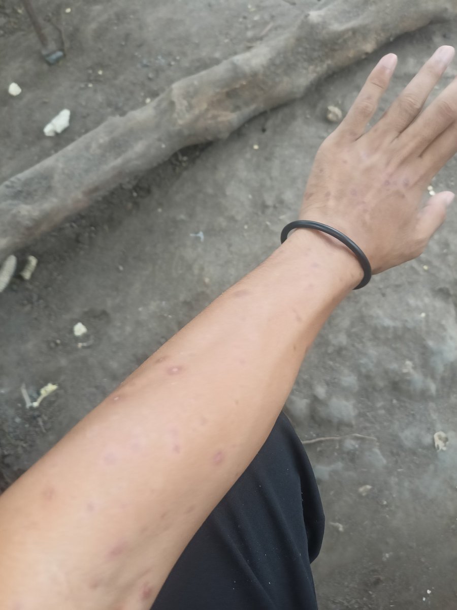 dave74476244's tweet photo. rashes turned into dark spots
mawawala pa po ba itong dark spots? https://t.co/e16kv22nb5
