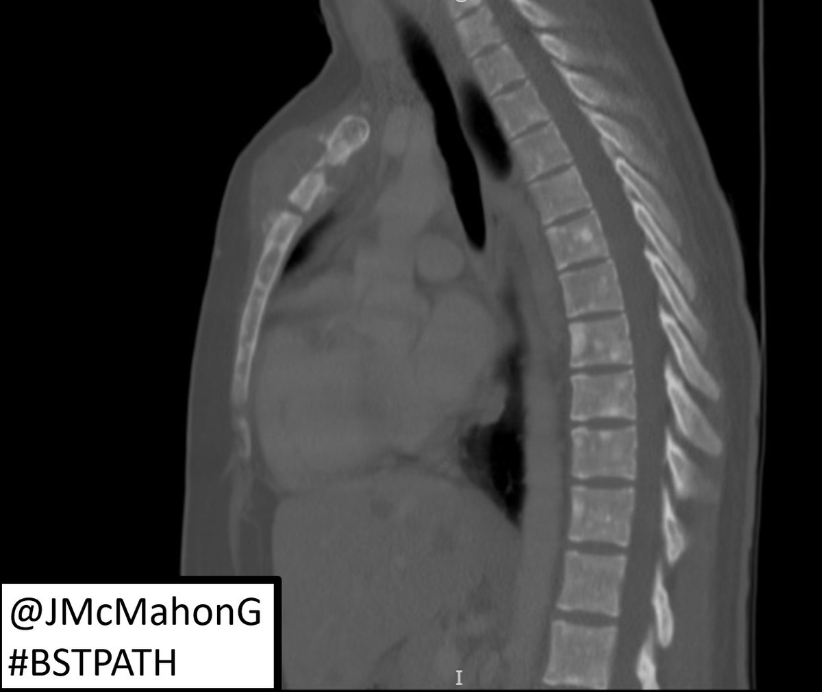 PRIMARY ANGIOSARCOMA OF BONE

Young adult developed a sternal mass with widespread metastases

Overtly malignant epithelioid / spindled cells with poorly-formed vascular lumina (notice the white "cracking" between the hyperchromatic nuclei)

#BSTPath #pathology #surgpath #MSKRad