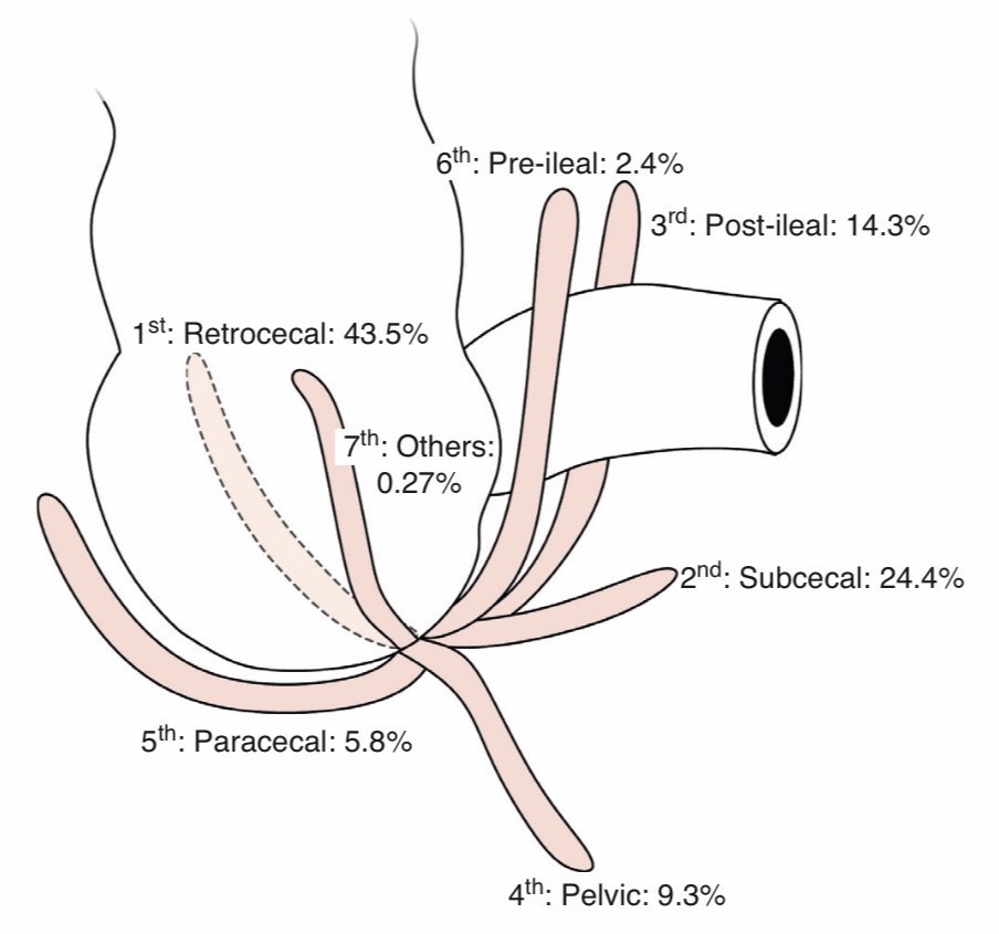 In open appendectomy ..
A- I take the cecum out then look for the appendix 

B- I try blind finger technique to take the appendix out 

Comment below 
#surgery