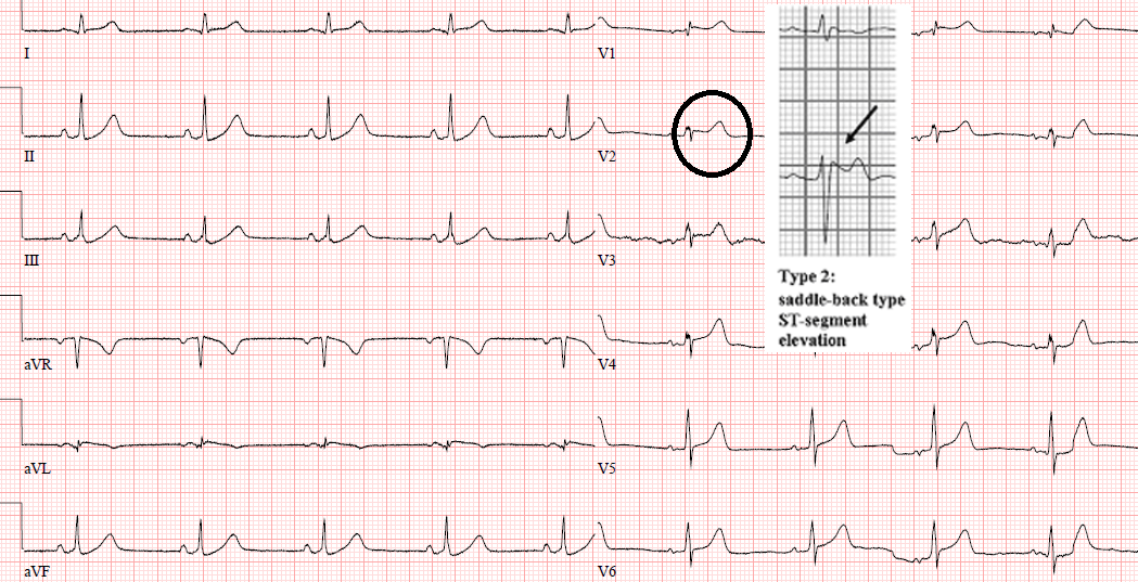 👋 Two Brugada patterns in one patient within 3 hours - Type 1 - Coved type and Type 2 - Saddle back type.
<a href="/WondrMedical/">Wondr Medical</a>