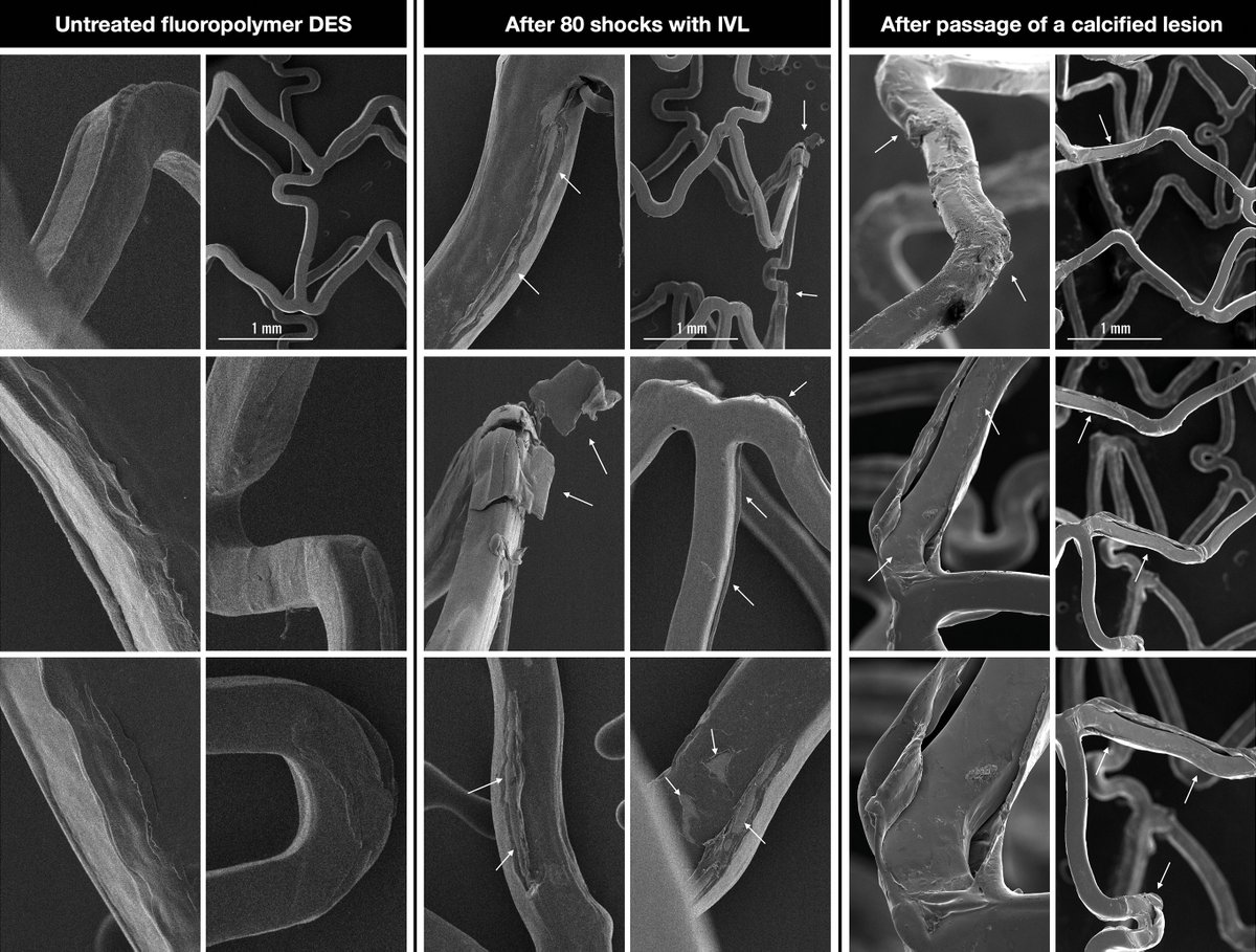 DFCapodanno's tweet photo. Intravascular lithotripsy interferes with the fluoropolymer of DES (e.g., small tears, micro-cracks and detachments of polymer flakes) but the overall integrity of the coating remains preserved. These changes also occur after high-pressure dilatation. https://t.co/UADnYw5s9o https://t.co/1D6L3wGdDm